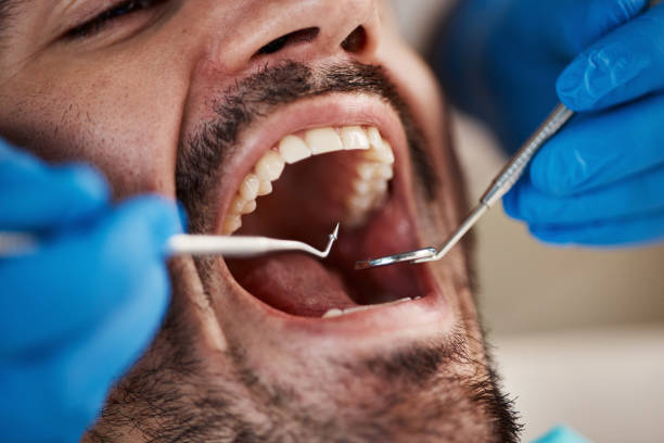 Best Emergency Root Canal Treatment in Notre Dame, IN